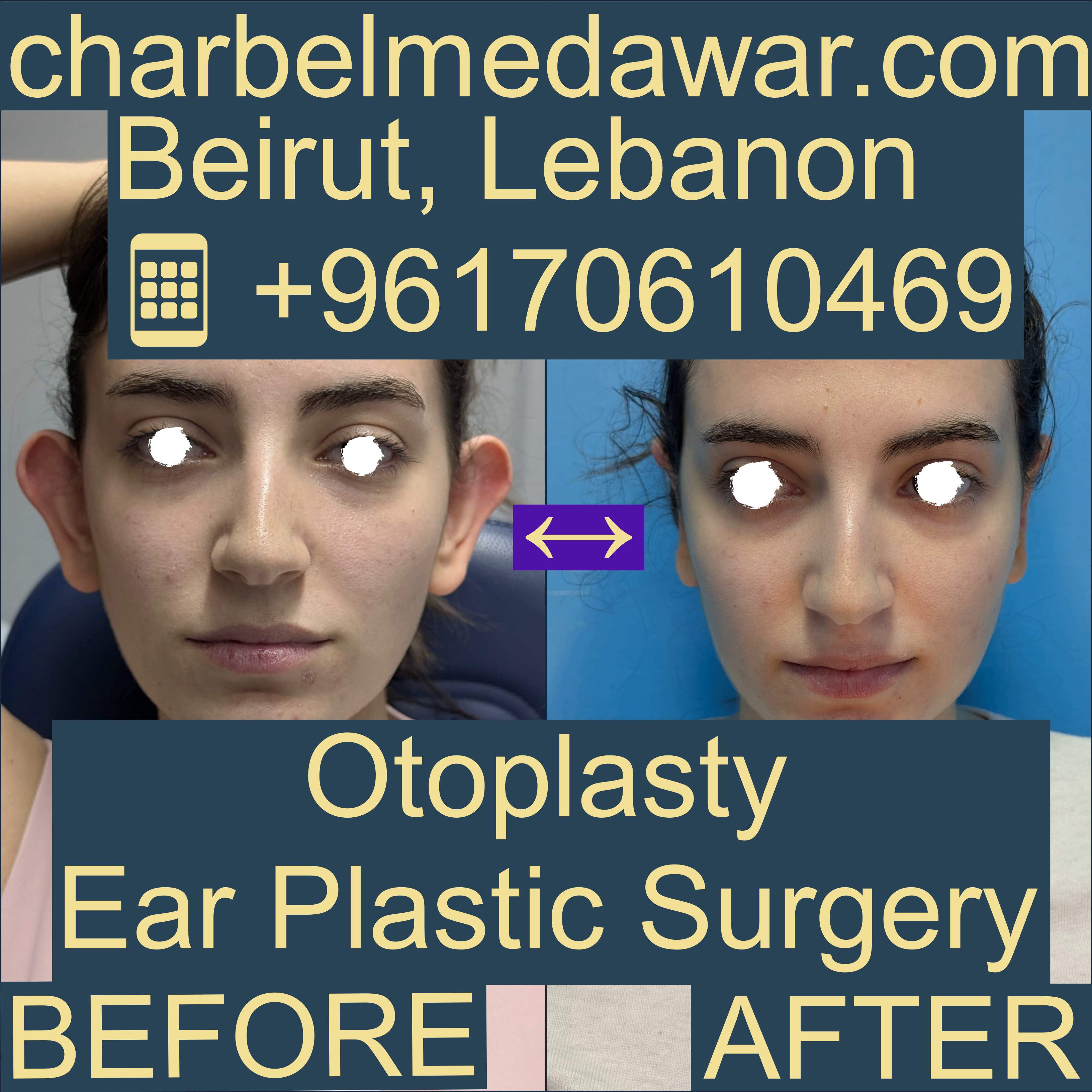 best otoplasty results lebanon