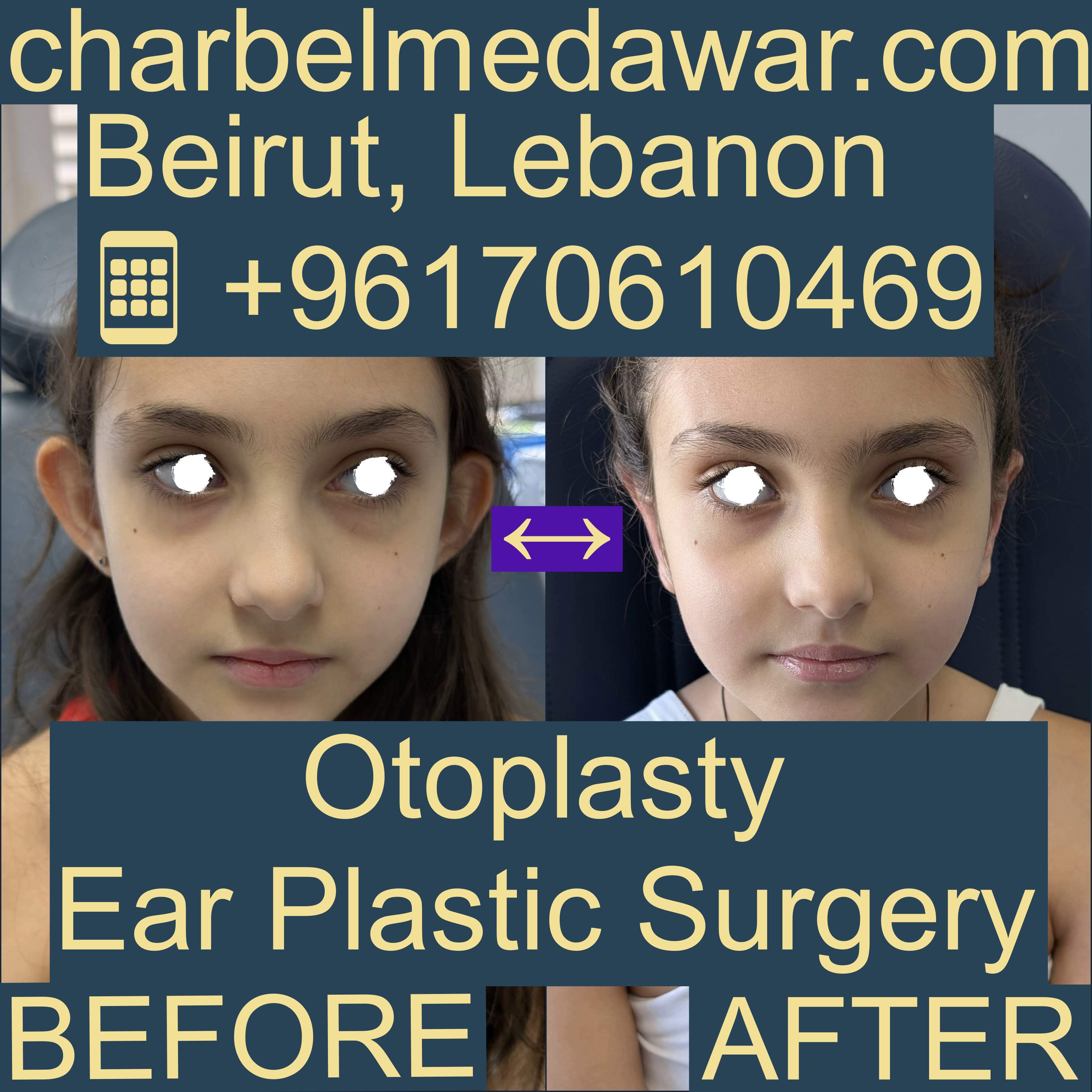 otoplasty surgery operation lebanon dr charbel medawar