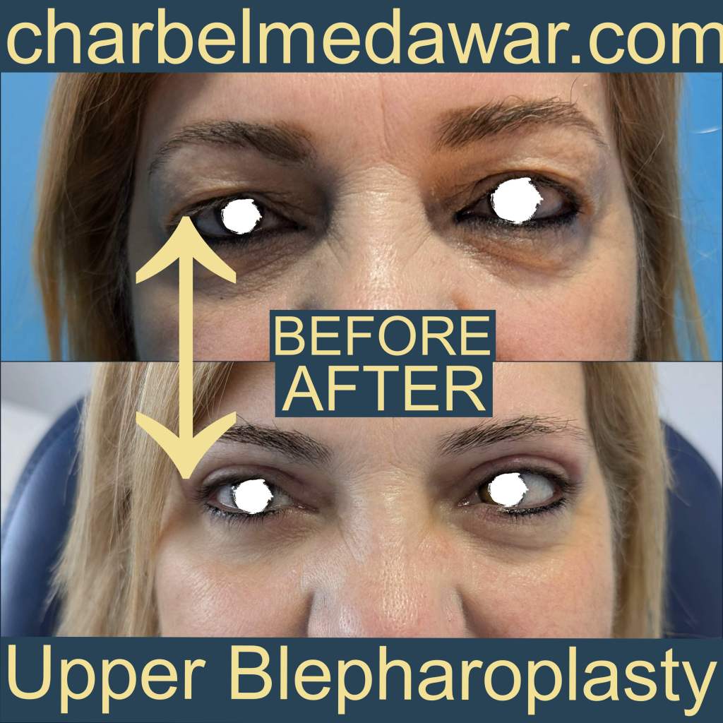 top blepharoplasty surgeon in lebanon dr charbel medawar