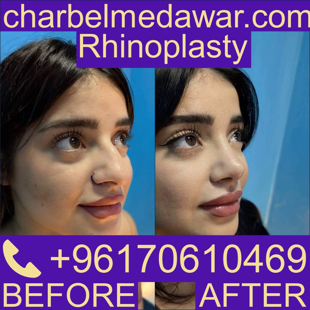 Lebanon Nosejob Lebanon Nosejob