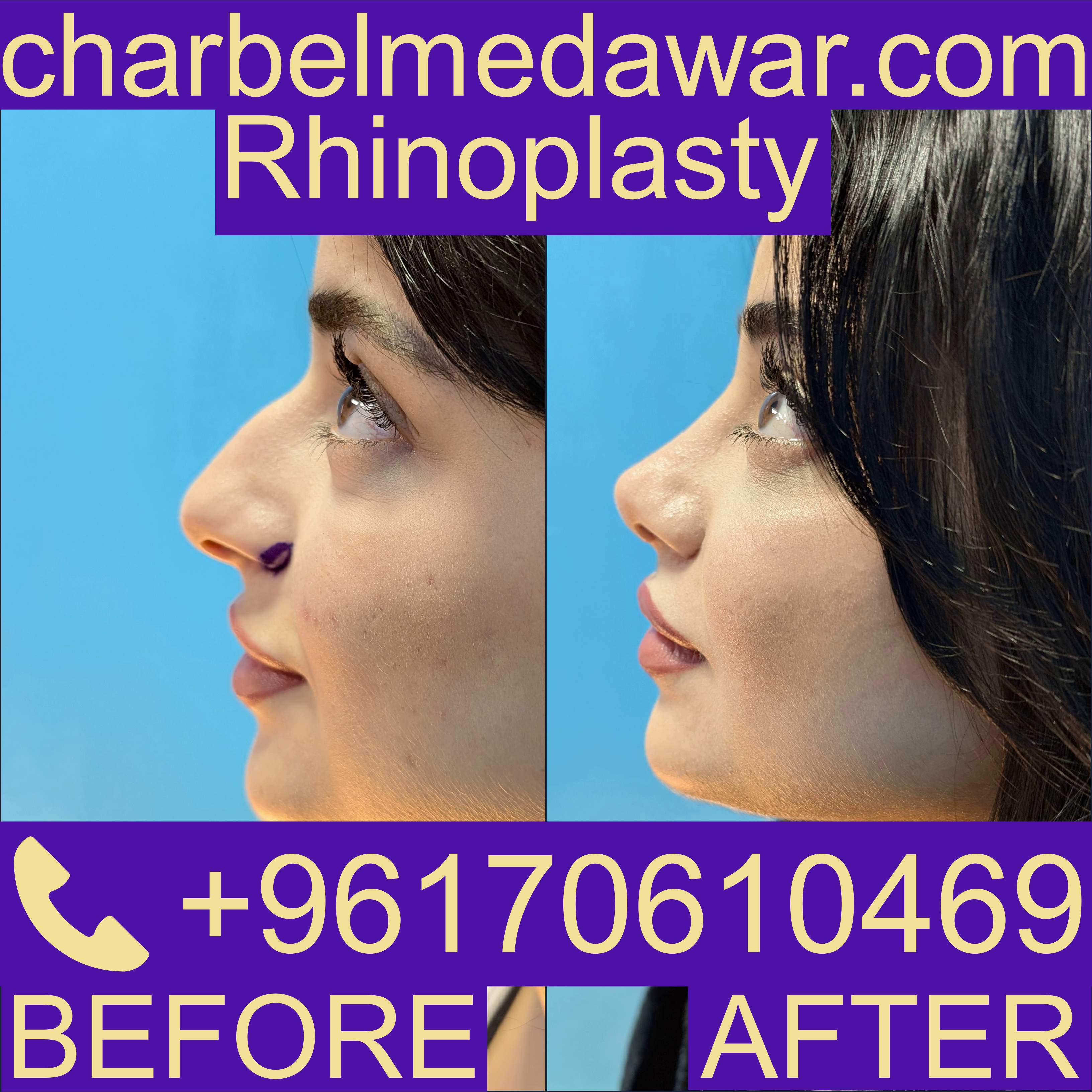 Lebanon Rhinoplasty
