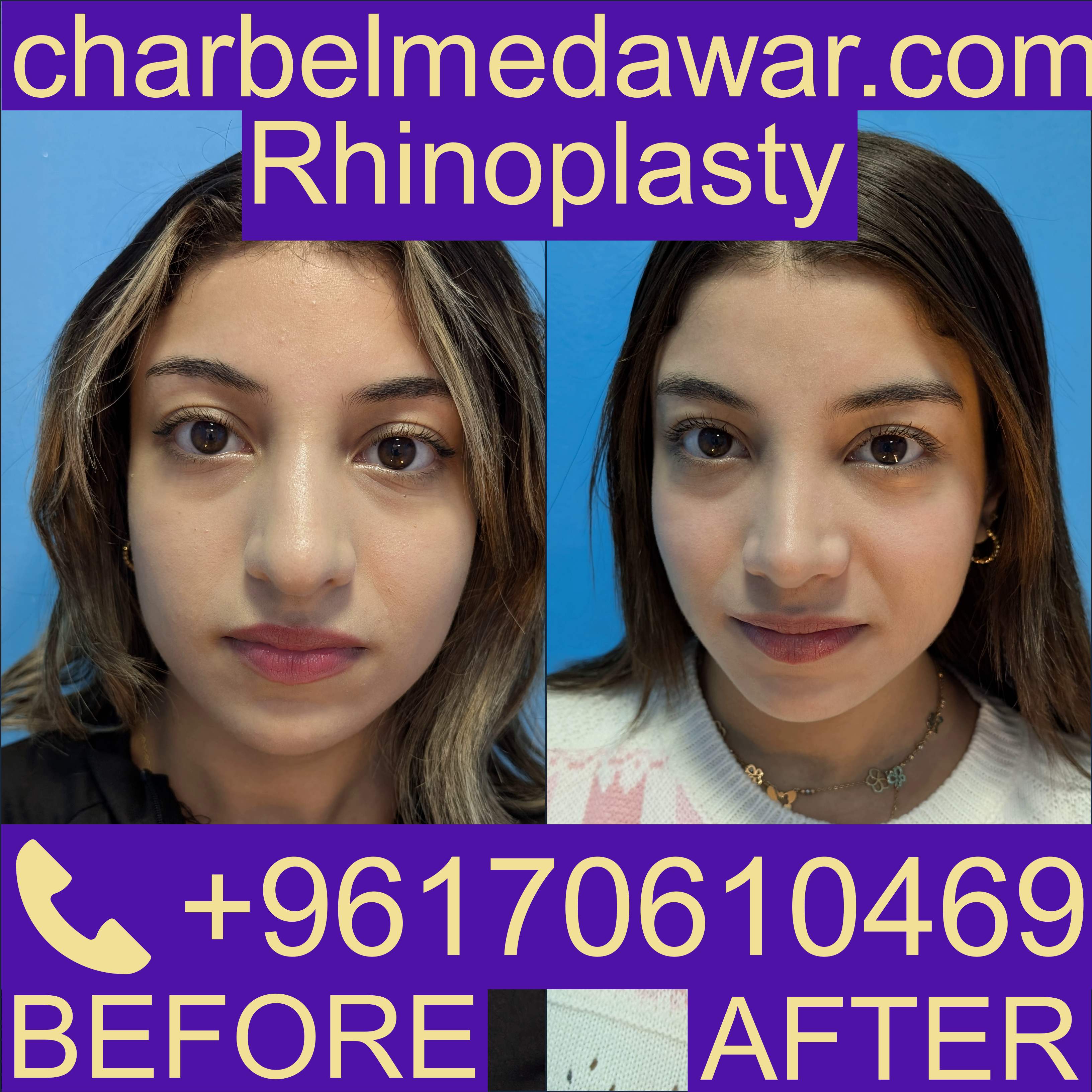 nose job lebanon cost