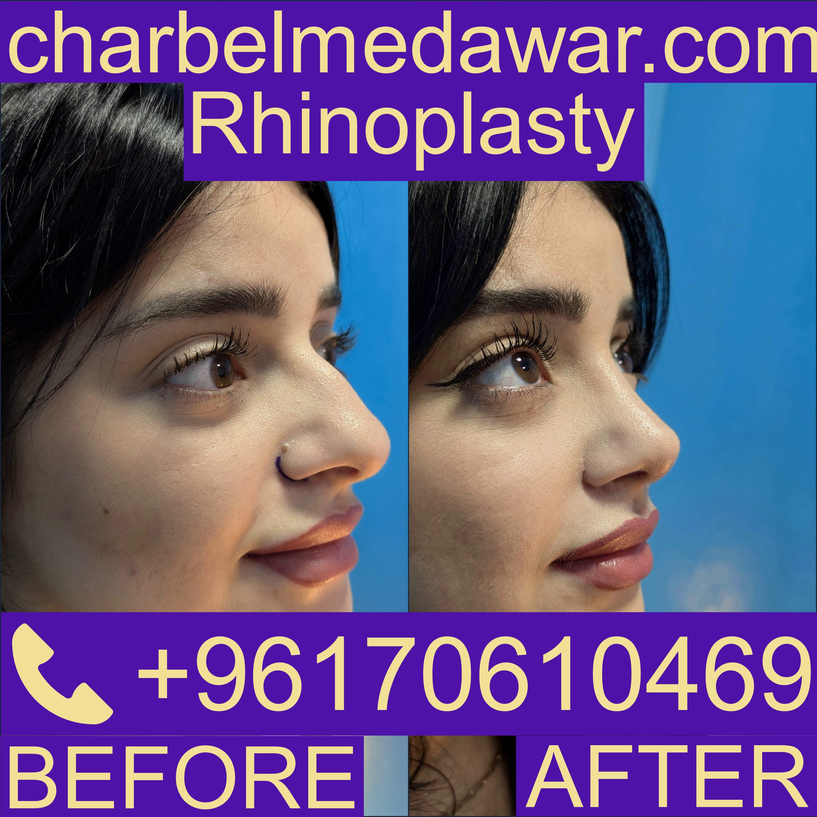 Nose Job Lebanon