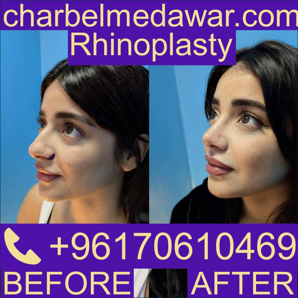 Nosejob Lebanon Nosejob Lebanon