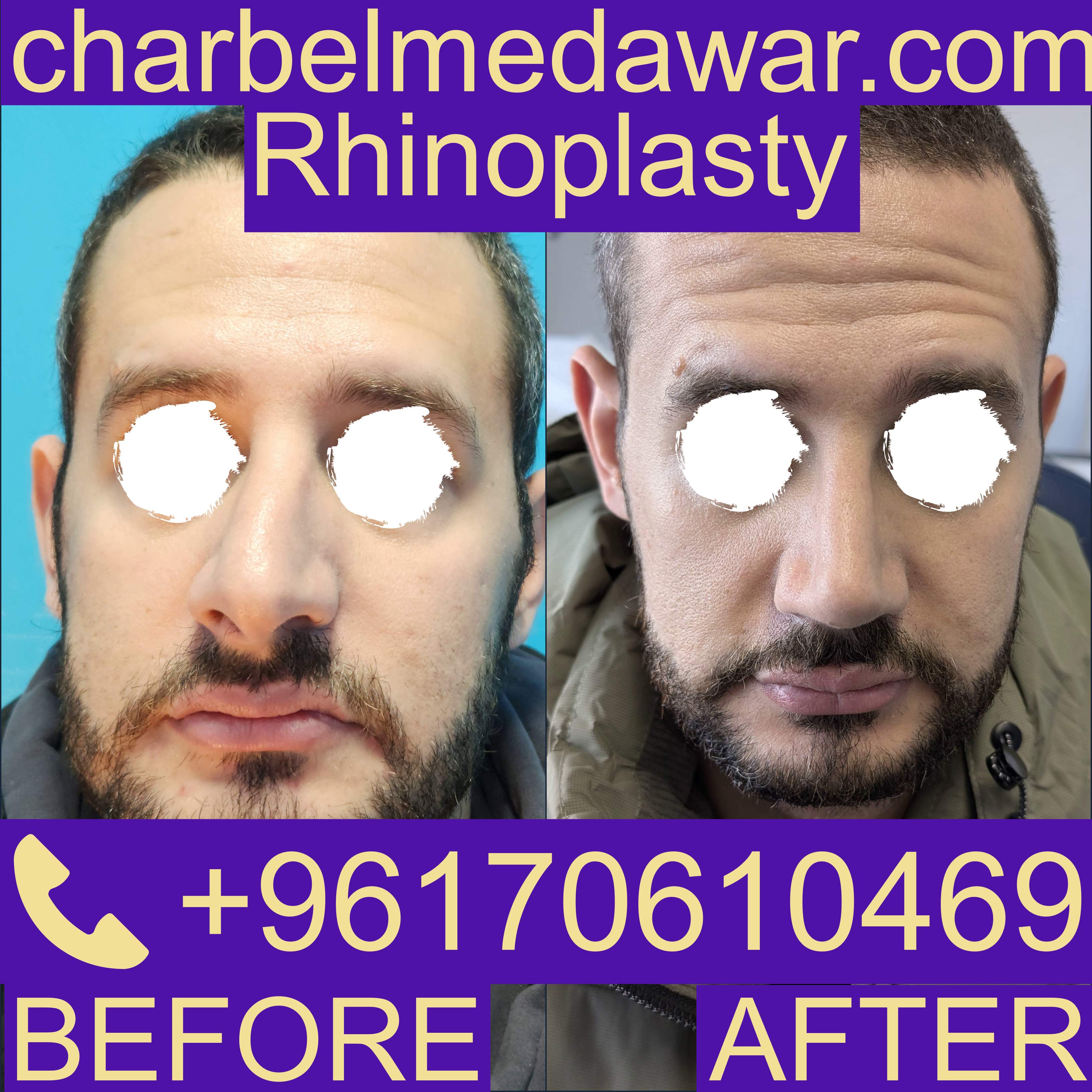 revision rhinoplasty lebanon