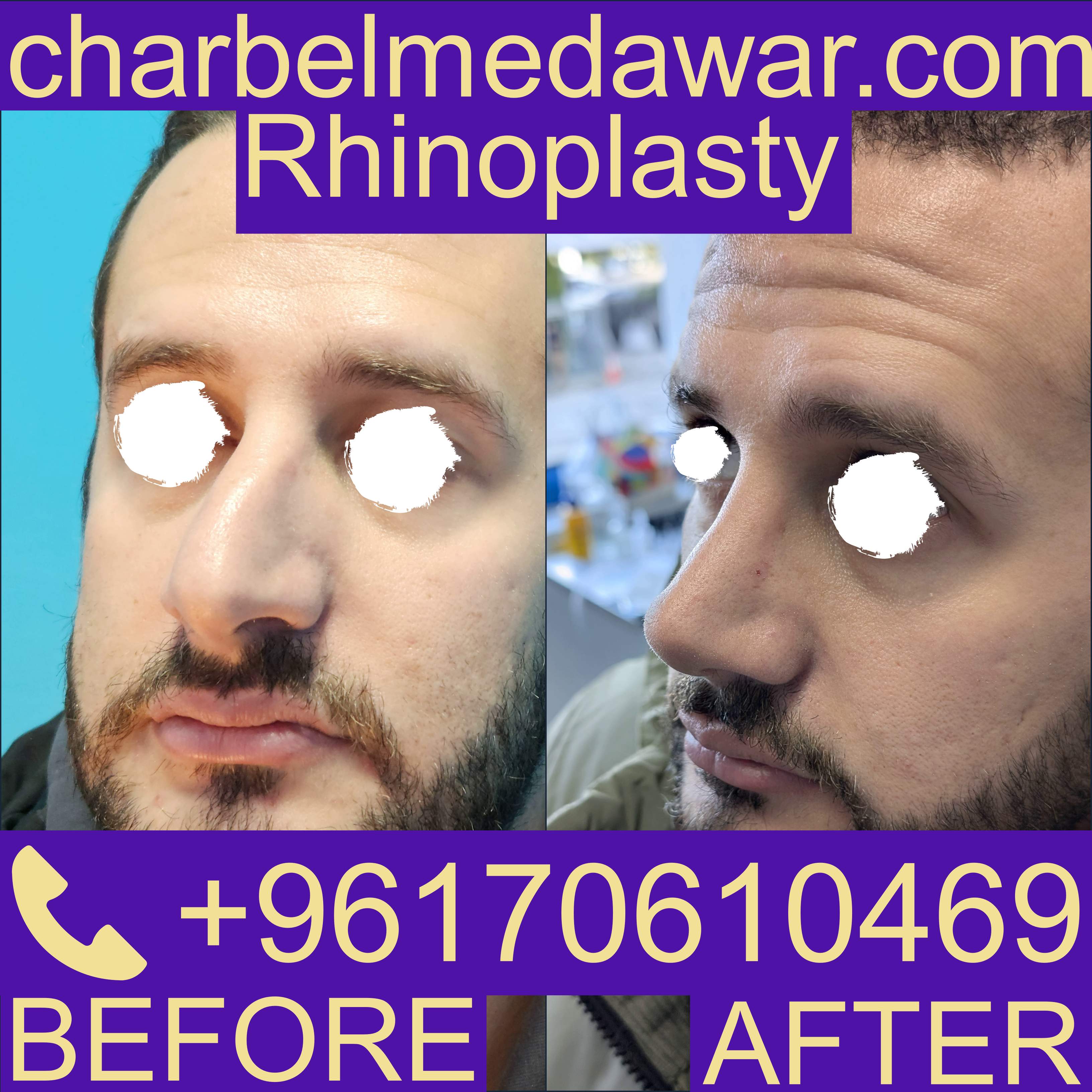 rhinoplasty cost in lebanon