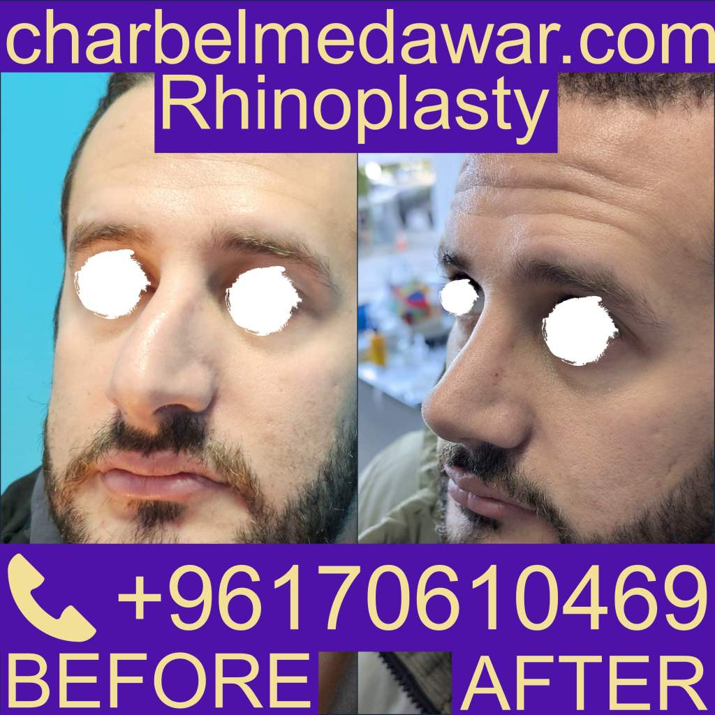 rhinoplasty cost in lebanon rhinoplasty cost in lebanon