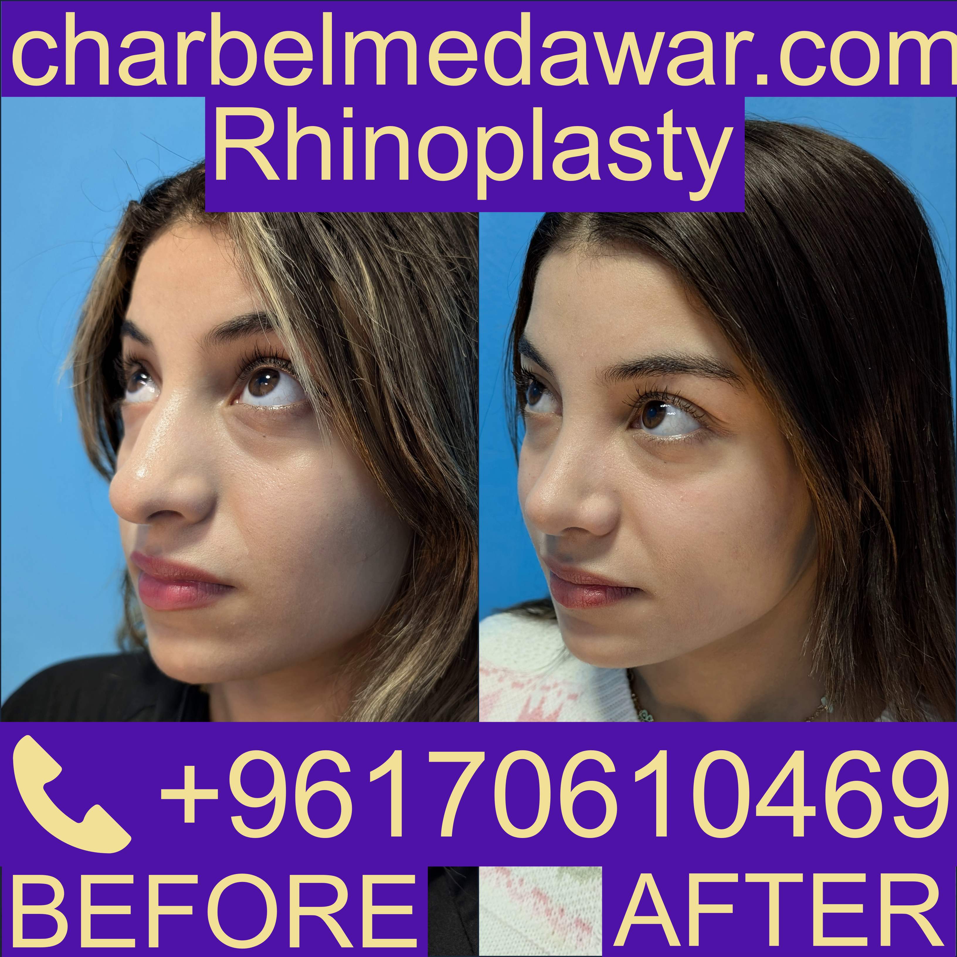 rhinoplasty cost lebanon