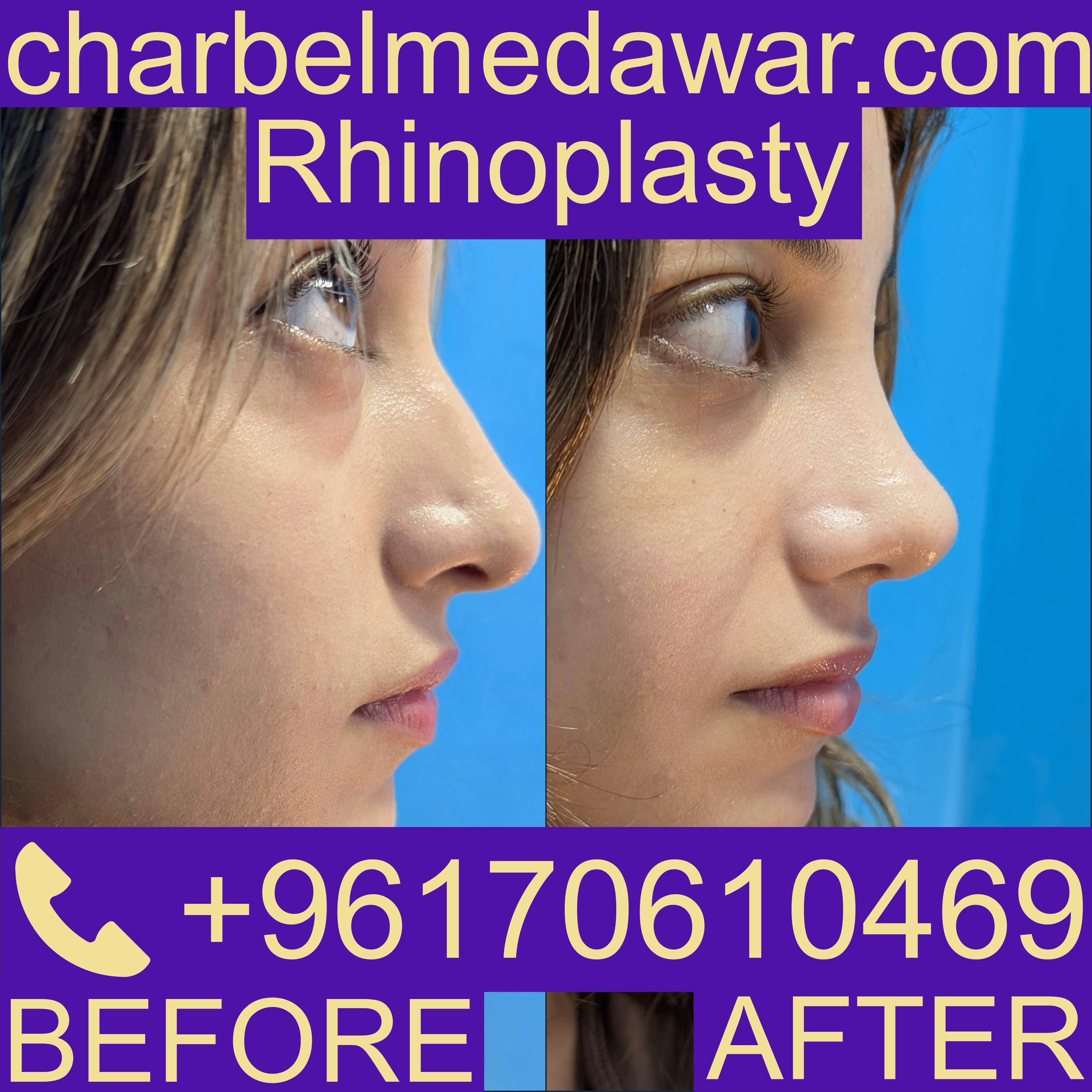 rhinoplasty lebanon price