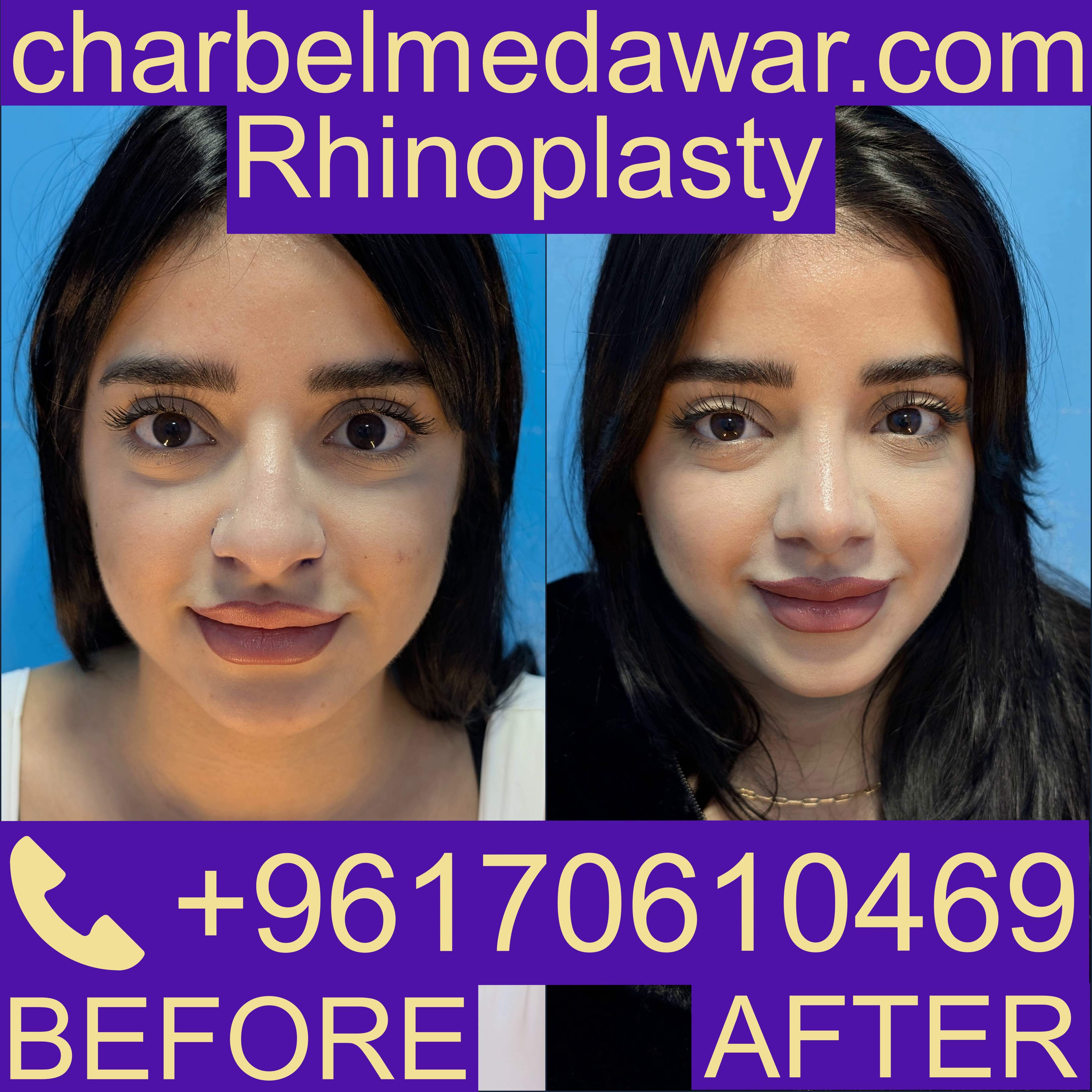 Rhinoplasty Lebanon