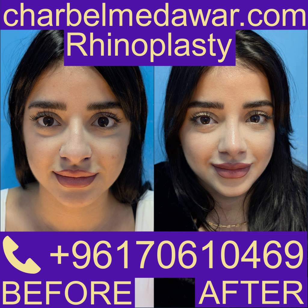 Rhinoplasty Lebanon