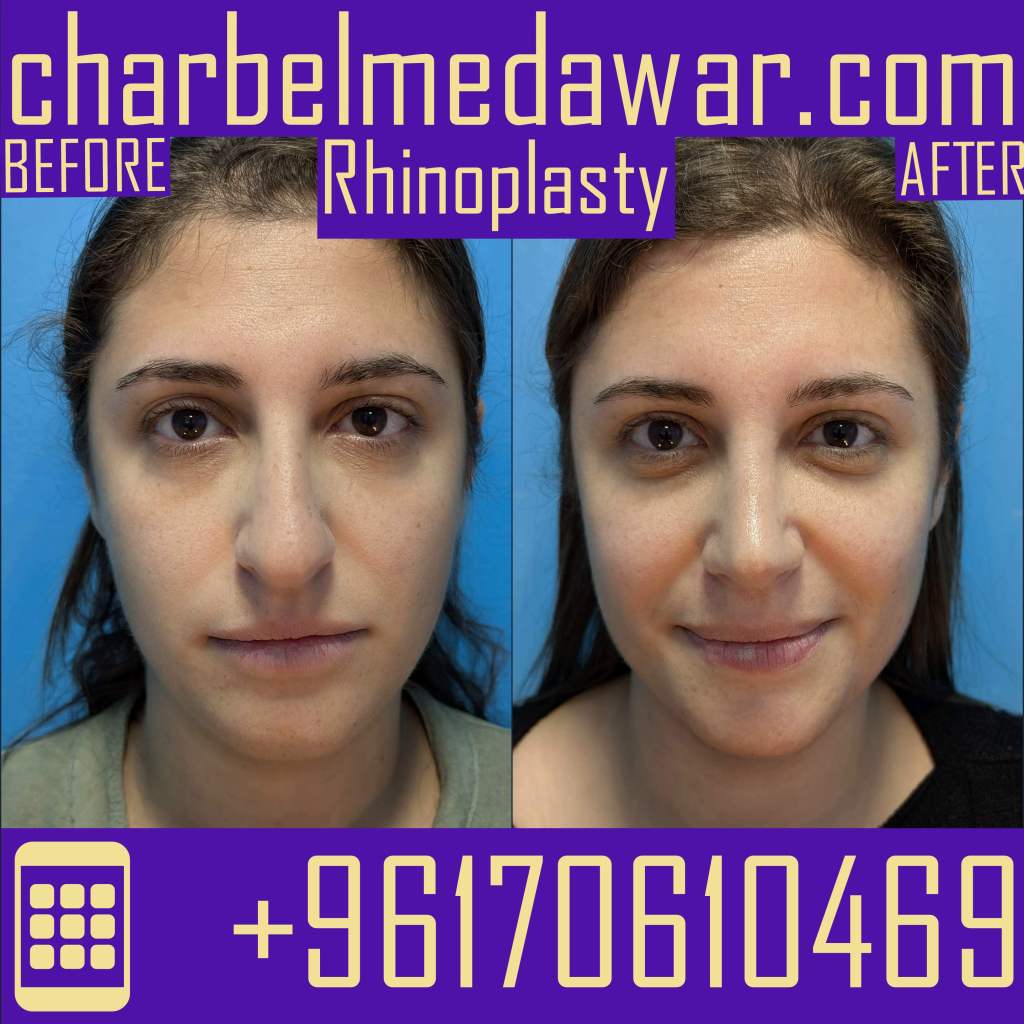 best nose plastic surgery lebanon