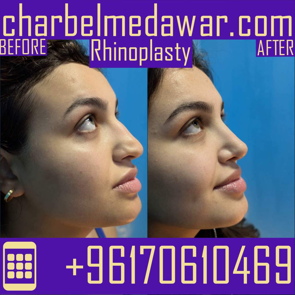 best plastic surgery lebanon