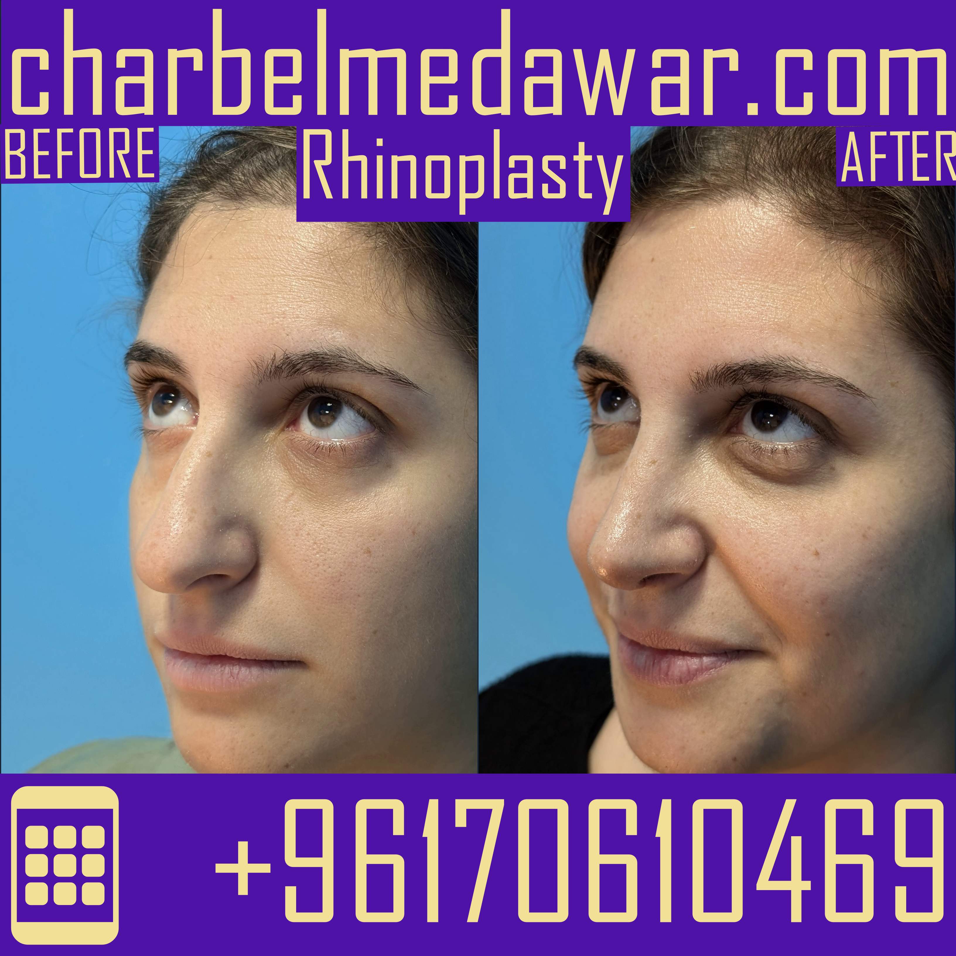 best rhinoplasty surgery lebanon