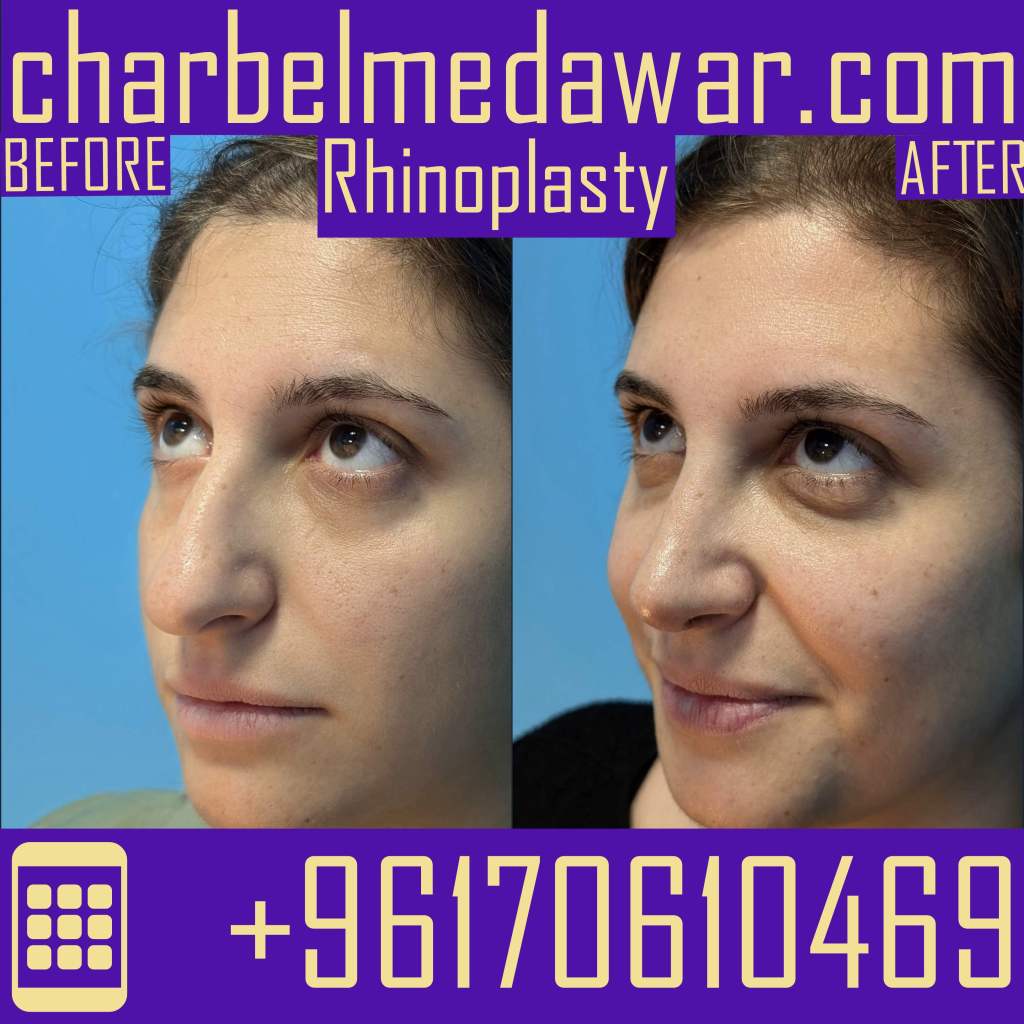 best rhinoplasty surgery lebanon