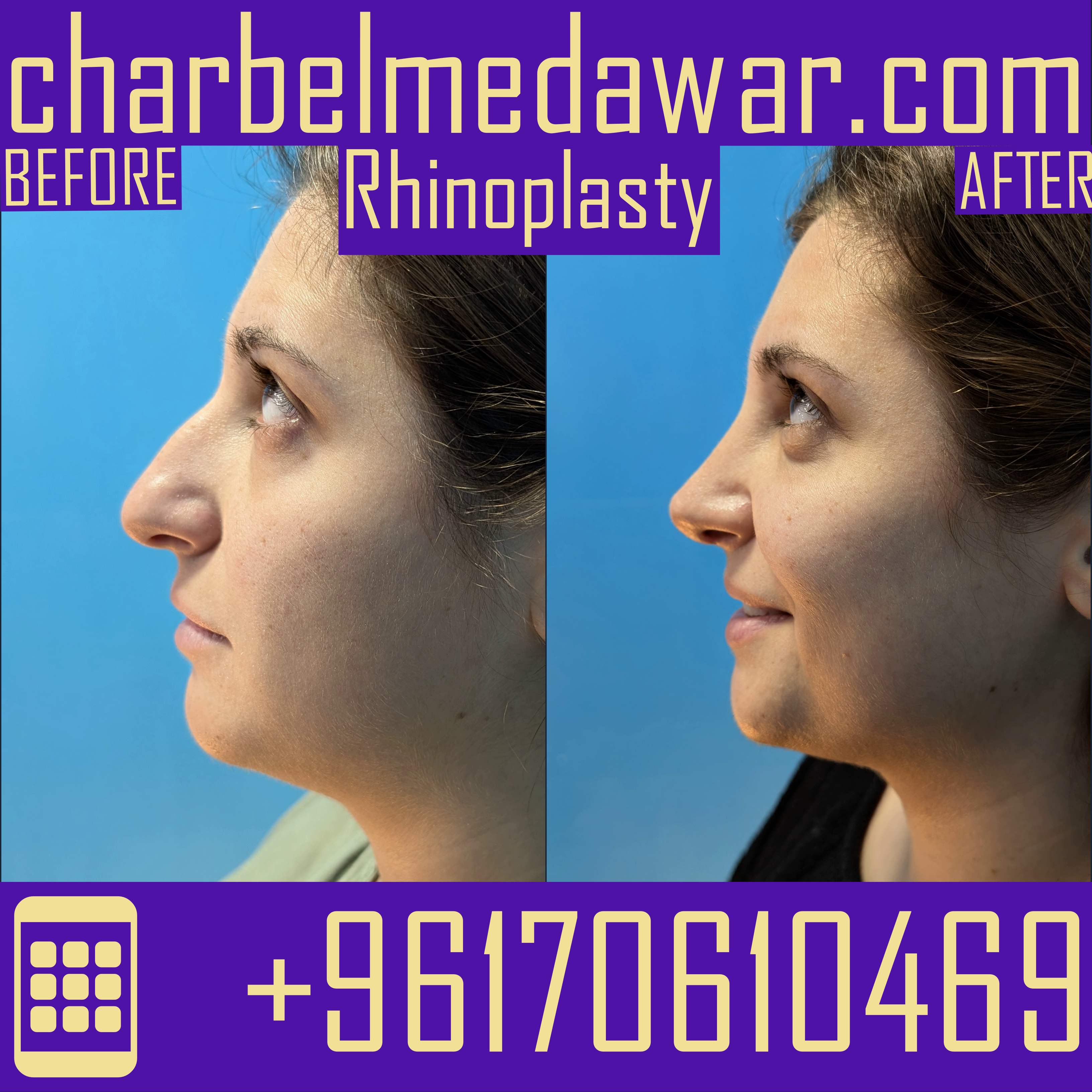 nose plastic surgery lebanon