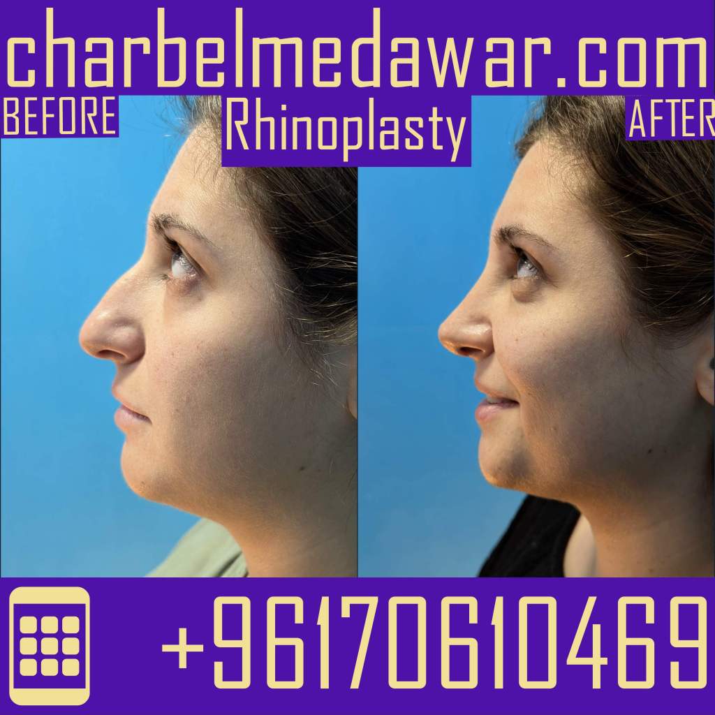 nose plastic surgery lebanon