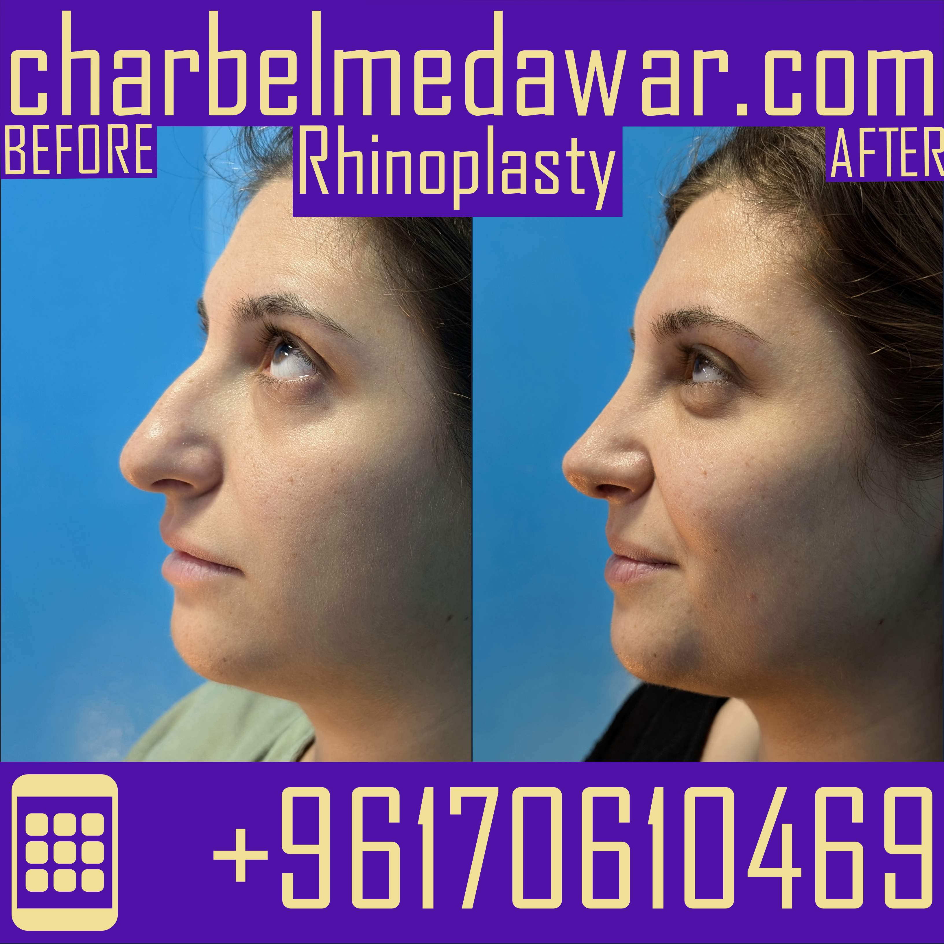 rhinoplasty surgery lebanon