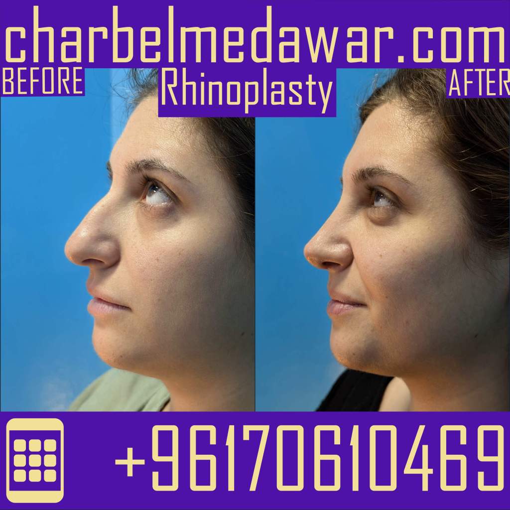 rhinoplasty surgery lebanon