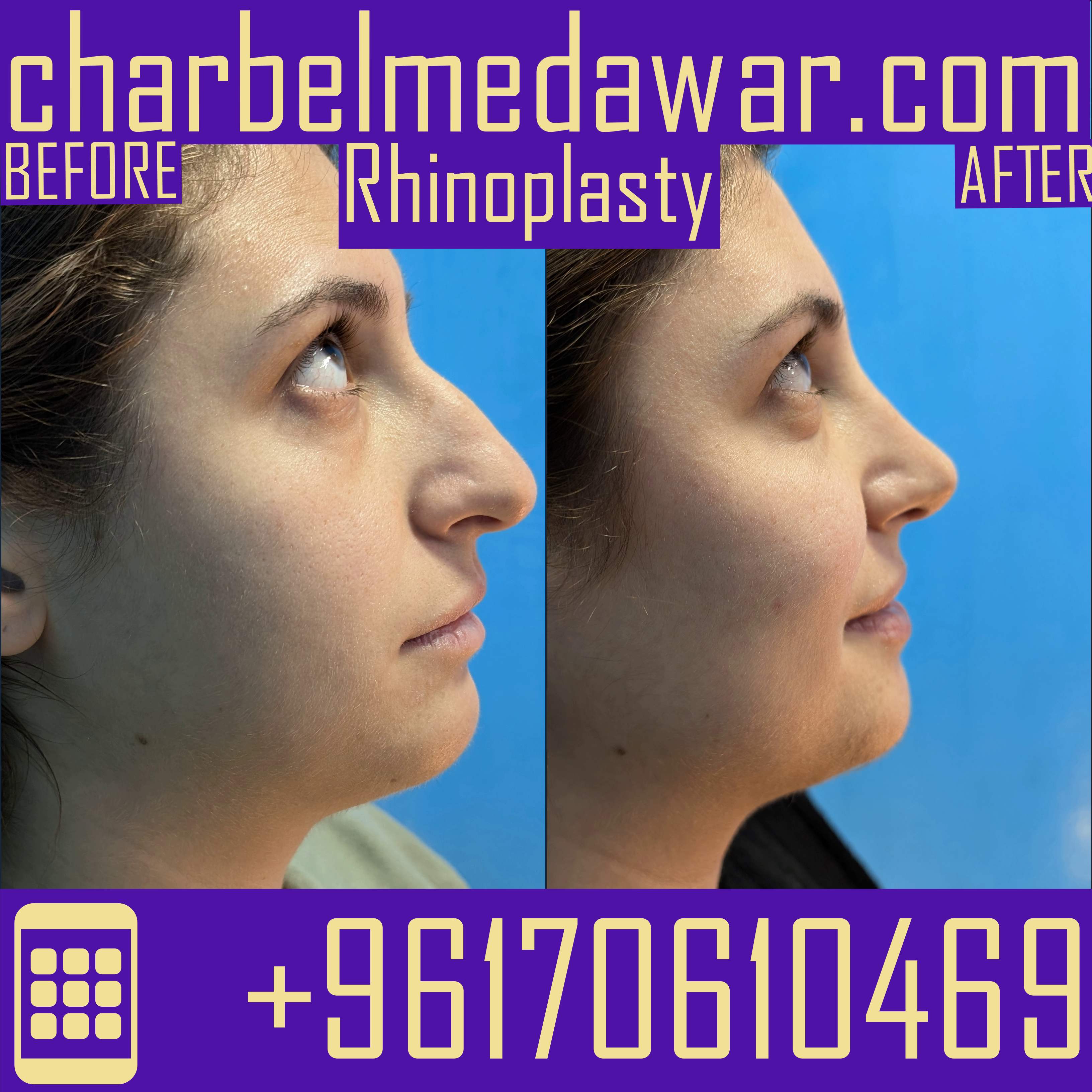 top rhinoplasty surgery lebanon