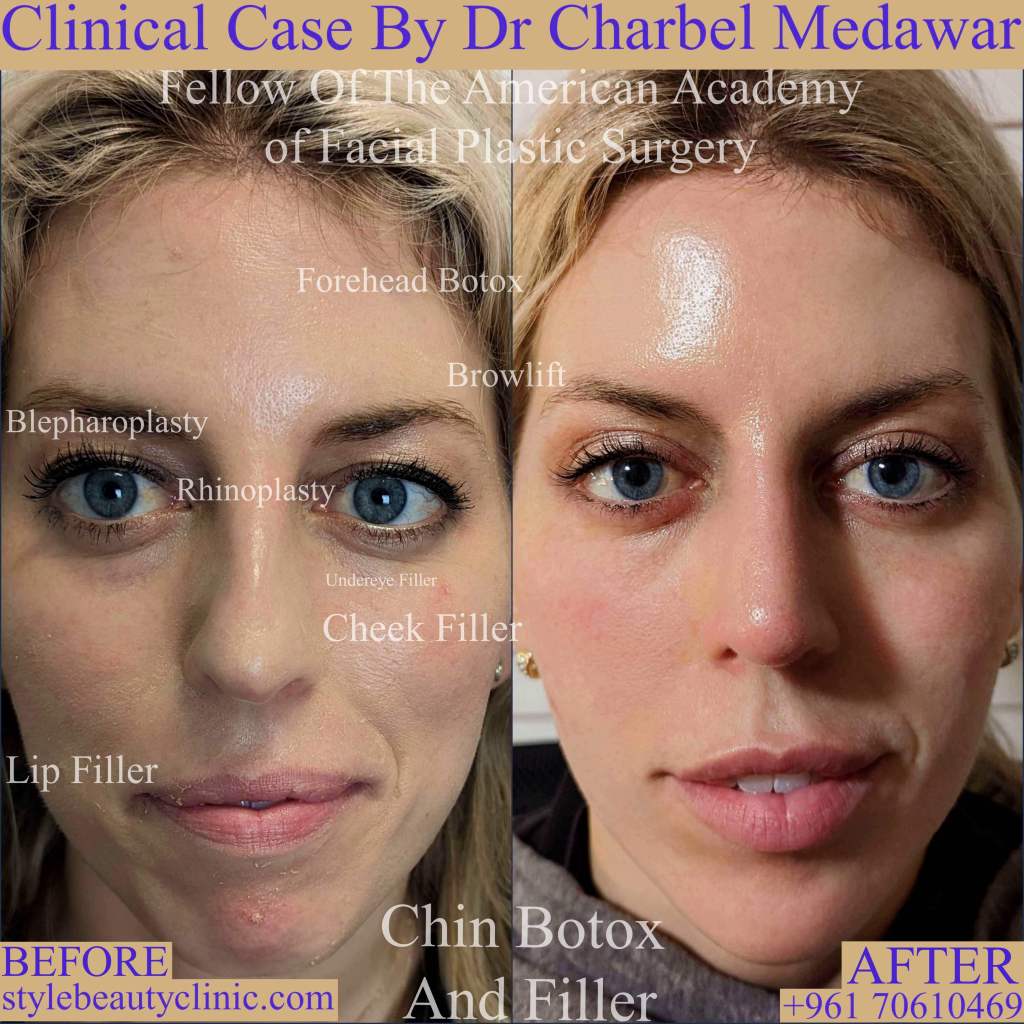 best cosmetic surgery in lebanon dr charbel medawar
