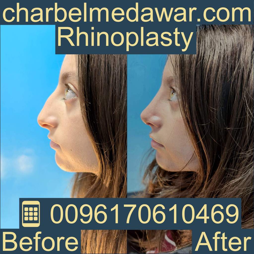 Best facial plastic surgeon in Beirut