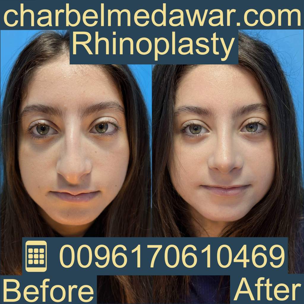 Cost of rhinoplasty in Lebanon 2026