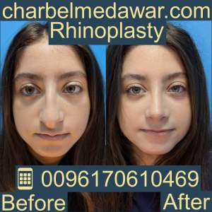 Cost of rhinoplasty in Lebanon 2026