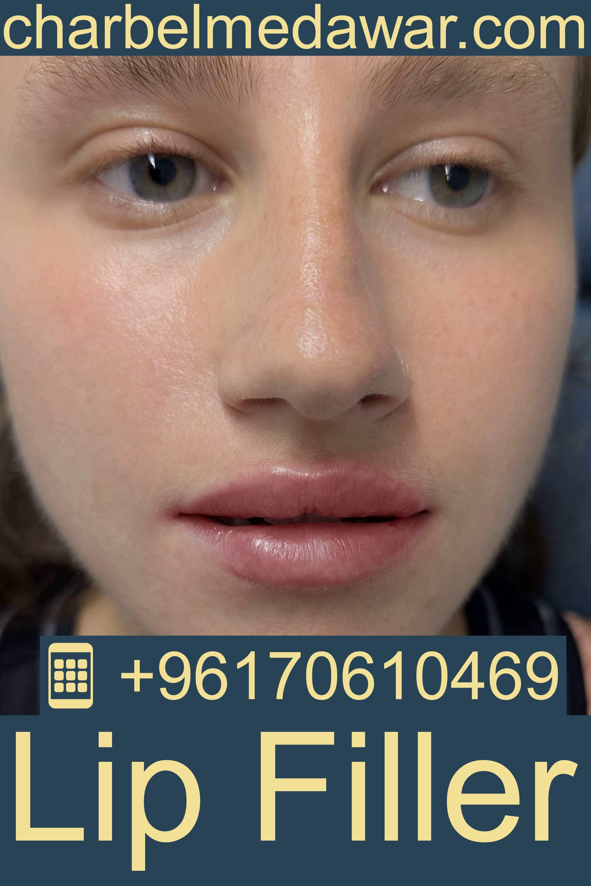 lip filler lebanon price 2026