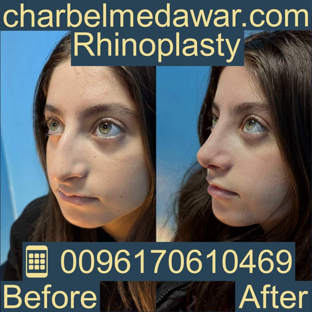 Revision rhinoplasty Lebanon